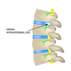 Hernia discal lumbar